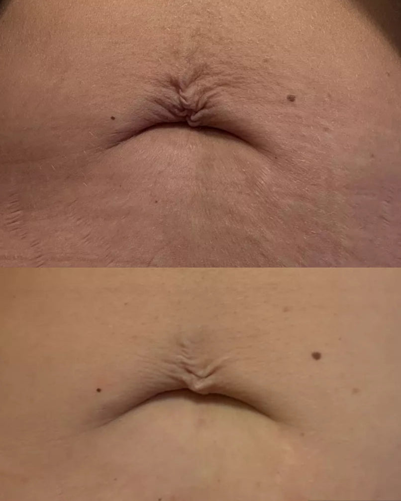 Before and after comparison of abdominal skin texture on a person.